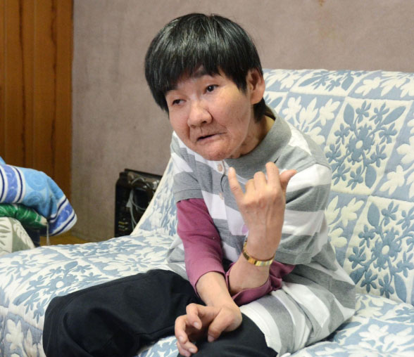 Bà Shinobu Sakamoto – người còn sống sau đại dịch nhiễm độc thủy ngân, bà bị nhiễm bệnh từ khi còn trong bụng mẹ.